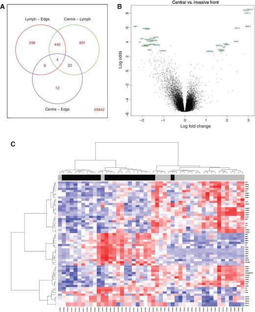Figure 1. Differential analysis and classifier generation. A, Venn diagram, produced using limma, of numbers of probe sets, which are differentially expressed between each region. The total number of DE genes increases as spatial distance from the CT increases. Right, bottom, the number of probes that do not appear in any of the three Venn sets is displayed. This indicates that there are very small but robust differences in the transcriptome of the CT compared with the IF. B, volcano plot depicting highest ranked DE genes between the central and IF regions. Gene symbols corresponding to each individual probe set identified are depicted. C, heatmap of central and IF samples clustered by expression values of the 30 genes in the supervised invasive classifier. Overlay bar depicts the region from which the sample originated, with black representing the CT and gray representing IF samples, confirming the robustness of the 30 genes used in classifying samples based on region-of-origin.