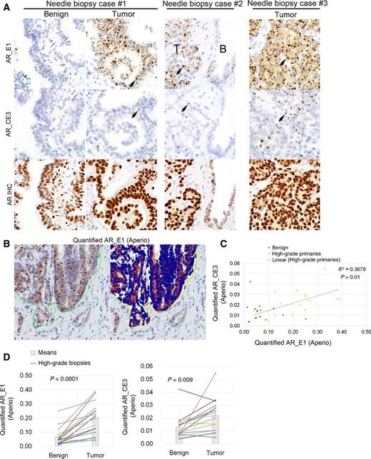 Figure 5. Measured in prostate needle biopsy specimens, AR-E1 and AR-CE3 expression are correlated and higher in Gleason 9–10 primary tumors compared with intermingled benign glands. A,representative primary tumor (T) and benign gland (B) labeling with AR-E1 and AR-CE3 RISH and AR IHC for AR protein. In case #1 and #2, both AR-E1 RISH and AR IHC are higher in tumor compared with adjacent benign glands. Both AR-E1 and AR-CE3 are localized in the cytoplasm as well as in nuclear punctae (arrows). B, RISH image quantification algorithm using Aperio Digital Pathology Software. The marked area (green) is enriched for tumor epithelium with minimal intervening stromal tissue and is quantified for RISH signals. Preset thresholds divide images into blue (unlabeled nuclei and some cytoplasm) and brown (RISH signal) pixels. Within the marked area, quantified RISH signal is expressed as the ratio of brown signals to (blue + brown) signals. C, quantified AR-CE3 versus AR-E1 for high-grade (Gleason 9–10) primary tumors and benign epithelium. There is a significant correlation between AR-CE3 and AR-E1 levels for the tumors. D, AR-E1 and AR-CE3 levels are significantly increased in tumor glands versus intervening benign glands in each case.