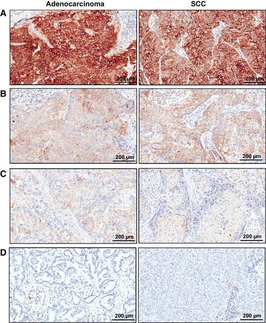 Figure 1. Microphotographs of representative examples of IHC PD-L1 expression in lung adenocarcinoma and SCC specimens. Four levels of staining (brown) are shown: strong (A; staining score, 3+), moderate (B; staining score, 2+), weak (C; staining score, 1+), and negative (D; staining score, 0).
