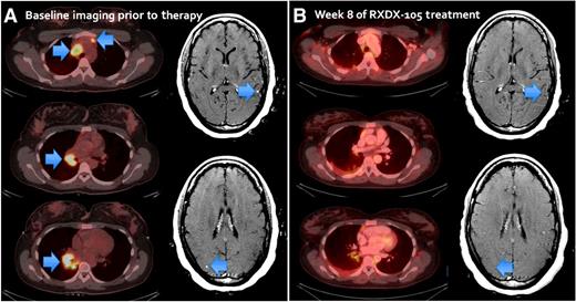 Figure 6. A rapid partial response was achieved after three weeks of therapy with RXDX-105. A, Baseline imaging prior to RXDX-105 treatment. Arrows indicate the lesions. B, Confirmation scan at week 8 with 64% decrease in tumor burden from the baseline, and almost complete resolution of subcentimeter asymptomatic brain metastases.