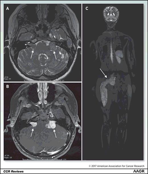 Figure 1. Characteristic imaging findings in a 12-year-old female patient with NF2. A and B, Axial FSE-T2 (A) and post-gadolinium–enhanced fat-suppressed T1-weighted images (B) through the internal auditory canals show bilateral vestibular schwannomas (arrows) with characteristic heterogeneous T2 signal and avid contrast enhancement. C, This same patient with NF2 also had extensive peripheral schwannomas, with whole-brain MRI showing extensive schwannomatous involvement of sacral nerve roots and sciatic nerve (arrow).