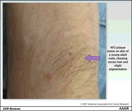 Figure 2. NF2 plaque lesion on skin of forearm. Slightly raised, slightly pigmented, with excess hair typical of NF2. Clinical features of NF2 (including diagnostic criteria).