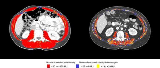 Figure 1. SMG and toxicity—both females BSA 1.70. Left, normal SMG (2,535 AU), had no toxicity; right, low SMG (844 AU), had grade 3/4 toxicity.