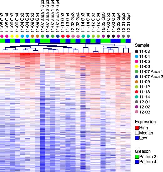 Gleason Score 7 Prostate Cancers Emerge through Branched Evolution of ...