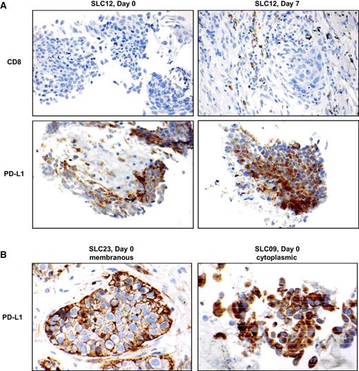 Figure 5. Tumor IHC staining with CD8 and PD-L1. A, Paraffin-embedded tumor tissues were stained with anti-CD8 and anti-PD-L1 on day 0 and day 7, and representative IHC staining images from SLC12 are shown. B, Representative IHC staining images of membranous and cytoplasmic expression of PD-L1 on day 0 from patients SLC23 and SLC09, respectively, are shown.