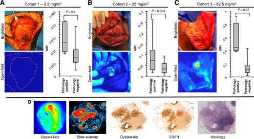 Figure 1. Intraoperative imaging of neck dissection. Representative brightfield and open-field (Luna, Novadaq) images are shown along with quantitative analysis of grossed lymph node fluorescence for cohort 1–2.5 mg/m2 dose group (A), cohort 2–25 mg/m2 dose group (B), and cohort 3–62.5 mg/m2 dose group (C). D, Representative closed-field (Pearl Impulse, LI-COR Biosciences) and fluorescence slide scanner (Odyssey, LI-COR Biosciences) acquisitions of grossed lymph node with adjacent IHC stains for cytokeratin and EGFR with matching histopathologic stain.