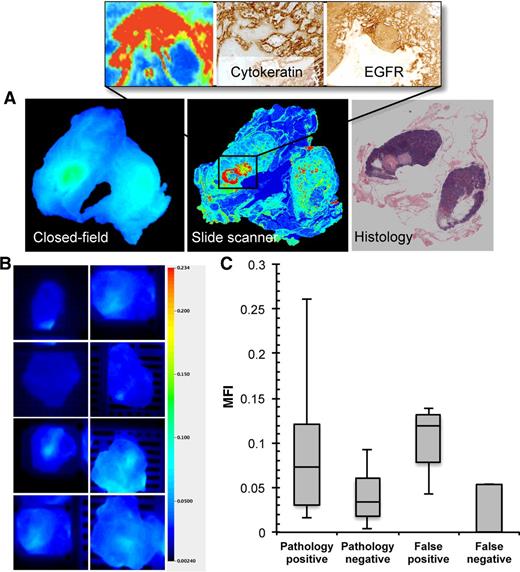 Figure 2. Identification of single false-negative lymph node. A, Closed-field and slide scanner fluorescence images of false-negative (histology positive, fluorescence negative) lymph node with adjacent histologic H&E section and inset 10× digital zoom with adjacent IHC stains for cytokeratin and EGFR. B, Threshold-matched closed-field imaging of true-negative (histology negative, fluorescence negative) lymph nodes from the same patient. C, MFI of pathology-positive, pathology-negative, false-positive, and false-negative lymph nodes during closed-field acquisition.