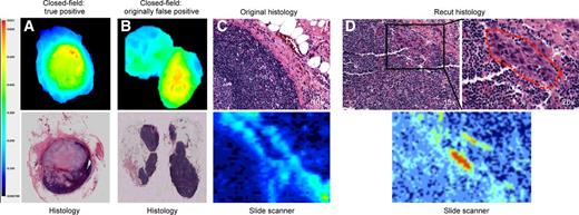 Figure 3. Representative overturned case. A, Closed-field acquisition with matching histopathology of true-positive lymph node. B and C, Closed-field acquisition (B) with matching histopathology and fluorescence slide scanner acquisition (C) of fluorescent lymph node originally diagnosed as pathology negative. D, Histopathology and fluorescence slide scanner acquisition of deeper (1 mm) recut section with small focus of cancer.