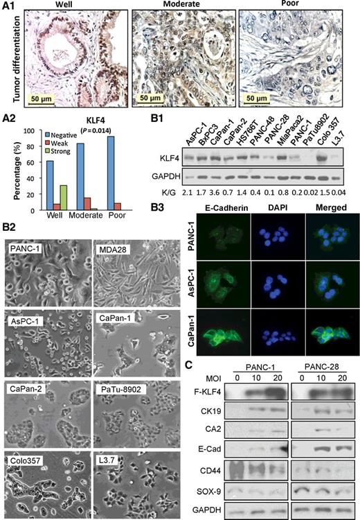 Figure 1. Relationship between KLF4 expression and pancreatic cancer differentiation. A, IHC analysis of KLF4 expression in pancreatic cancer tissues. Representative images of KLF4 expression in different tumor grades (A1) and the overall KLF4 expression associated with tumor differentiation (A2, Fisher's exact test, P = 0.014). B, Western blot analysis of KLF4 expression in pancreatic cancer cell lines, with relative KLF4 level expressed as K/G (KLF4/GAPDH) shown in below (B1); morphologic images of related cell lines (B2); immunofluorescent (IF) staining of E-Cadherin expression in related cell lines (B3). C, Western blot analysis of Flag-KLF4 and related protein expressions in pancreatic cancer cells at 48 hours after transduction of Ad-KLF4 viral vectors. Ad-GFP viral vectors were used as a control or to make the total multiplicity of infection (MOI) equal in each group.