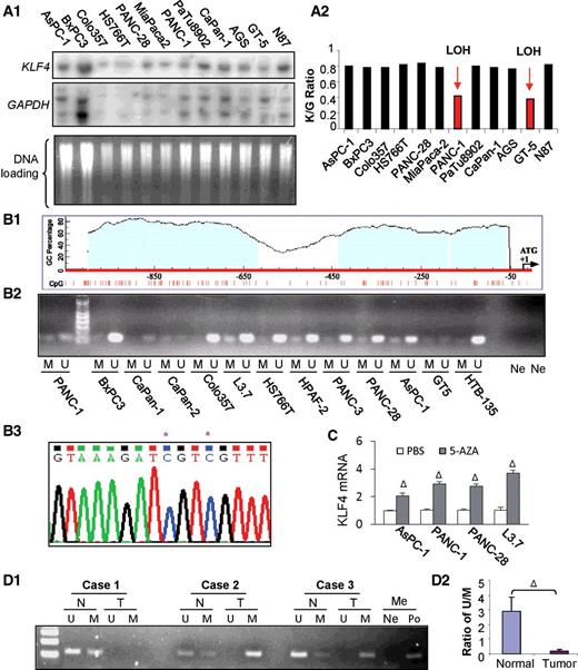 Figure 2. Genetic and epigenetic alterations of KLF4 in pancreatic cancer. A, Southern blot analysis of KLF4 gene status in pancreatic cancer cell lines and previously examined gastric cancer cell lines were included for controls. Representative blot images with related probes (A1) and the ratio of KLF4/GAPDH signal intensity for normalization and comparison (A2). B, Diagram of CpG sites and CpG islands in the promoter region of KLF4 gene (B1). Methylation-specific PCR analysis of DNA methylation using primers specific for the unmethylated (U) or methylated (M) KLF4 promoter region using the genomic DNA extracted from pancreatic and gastric cancer cell lines (B2). Note: Ne, H20 was used as a negative control for the primers of U and M, respectively. Bisulfite–DNA sequence analysis confirmed the existence of KLF4 promoter methylation in L3.7 cells (B3). Note: *, methylated C in CpG sites. C, Poorly differentiated pancreatic cancer cells were cultured in the presence of AZA (1 μmol/L) or not (PBS) for 3 days. Total RNA was extracted and used for RT-qPCR analysis of KLF4 mRNA expression. D, Methylation-specific PCR analysis of genomic DNA extracted from laser-capture microdissection samples of paired pancreatic normal (N) and tumor (T) tissues (D1), with an average ratio of U/M shown in D2. Note: H20 (Ne) and methylation-positive DNA sample (Po) were used with methylation-specific primers, respectively; ΔP < 0.01 versus control (See also Supplementary Figs. S1 and S2).
