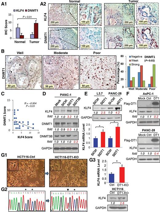 Figure 3. Comparison of DNMT1 and KLF4 expressions in pancreatic cancer tissues determined by IHC analysis. A, Average scores of KLF4 and DNMT1 immunostaining in tissue arrays containing paired pancreatic normal and cancer tissue sections (ΔP < 0.01 vs. normal; A1), and representative imaging of IHC staining (A2). B, Representative images of DNMT1 expression in different tumor grades (left 3) and the overall DNMT1 expression associated with tumor differentiation (right, Fisher's exact test, P = 0.019). C, Correlation analysis of overall KLF4 and DNMT1 expressions in pancreatic cancer tissue array. D, Western blot analysis of KLF4 protein expression in PANC-1 cells at 48 hours posttransfection of DNMT1 or DNMT3 siRNA. E, Western blot (top) or RT-qPCR (bottom) analysis of KLF4 expression at 48 hours posttransfection of DNMT1 siRNA in the cell lines indicated. F, Western blot analysis of KLF4 protein expression at 48 hours posttransfection of DNMT1 expressing vector in the cell lines indicated. G, Morphorlogic images of HCT116 Ctr or with DNMT1 gene knockout (HCT116-DT1-KO) cells (G1); Bisulfite–DNA sequence analysis confirmed reduced KLF4 promoter DNA methylation in HCT116-DT1-KO cells when compared with HCT116-Ctr cells (G2), which is consistent with the results of RT-qPCR or Western blot analysis of KLF4 expression in HCT116-Ctr and HCT116-DT1-KO cells (G3; See also Supplementary Fig. S3) (*P < 0.05).