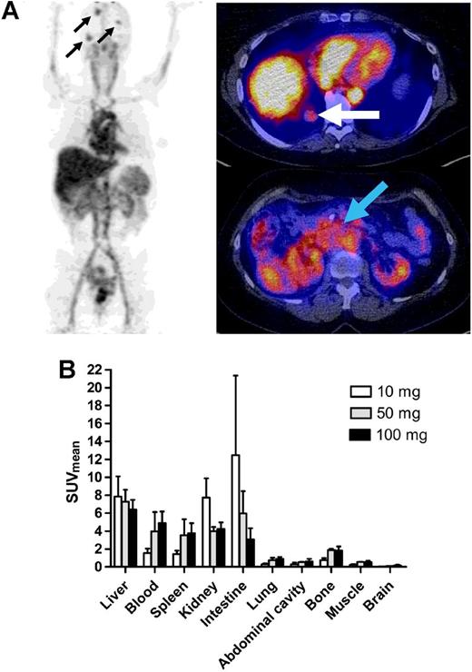 Figure 1. A,89Zr-lumretuzumab PET scan with 100-mg unlabeled lumretuzumab 4 days after injection with representative whole body tracer distribution and tracer uptake in multiple brain metastases (black arrows), one lung metastasis behind the liver (white arrow), and the primary tumor (cancer of the ampulla of Vater, blue arrow). B, 89Zr-lumretuzumab organ biodistribution 4 days after injection for different doses of unlabeled lumretuzumab; 10-mg unlabeled lumretuzumab in white bars (n = 2), 50-mg unlabeled lumretuzumab in gray bars (n = 2), 100-mg unlabeled lumretuzumab in black bars (n = 16).