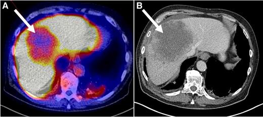 Figure 2. 89Zr-lumretuzumab PET (A) and diagnostic CT scan (B) of the liver of patient 4. The liver metastasis (white arrow) is visually cold on the 89Zr-lumretuzumab PET scan 7 days after injection of the tracer with additional 50-mg unlabeled lumretuzumab.