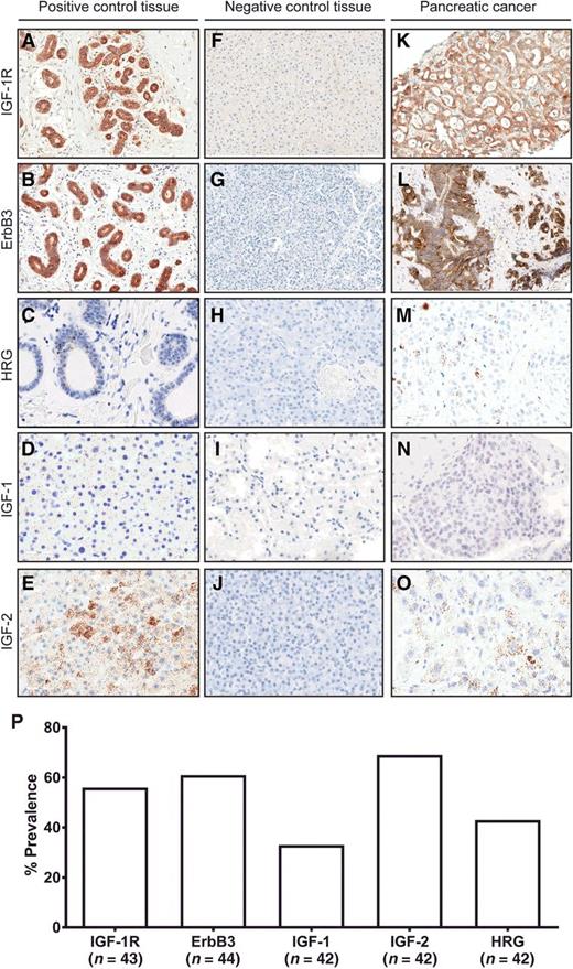 Figure 2. Expression of IGF-1R, ErbB3, and their ligands (IGF-1, IGF-2, and HRG) in human metastatic pancreatic cancer tissue. A–O, Representative images of IGF-1R and ErbB3 IHC (diffuse brown staining) and representative images of IGF-1, IGF-2, and HRG RNA in situ hybridization (RNA-ISH, punctate dots in cells) from pancreatic cancer tissues are shown next to normal control tissues. Positive and negative controls include normal breast tissue (A–C), normal liver tissue (D–F), normal pancreas tissue (G–H, J), and normal kidney tissue (I). P, A panel of metastatic pancreatic tumors was profiled for expression of IGF-1R, ErbB3, and their respective ligands. IHC specimens were scored by a pathologist using the clinical HER2 scoring system criteria (IHC positivity is considered ≥1+ in 10% of tumor cells), and ISH specimens were scored by quantifying dots/cell (ISH positivity is considered ≥1 dot/cell in at least 10% of tumor or stromal cells).