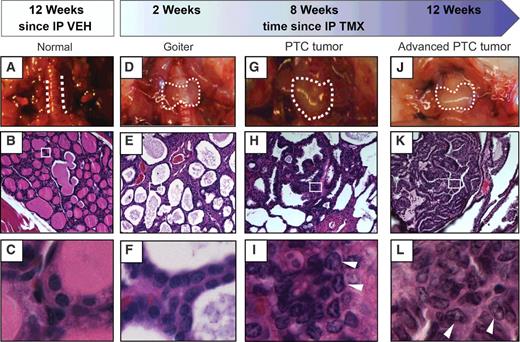Figure 2. Histology and gross pathology of thyroid tumor development in TBP mice. Samples from euthanized TBP mice at the indicated time points after an intraperitoneal injection of vehicle (VEH, A–C) or tamoxifen (TMX, D–L). Top: Gross pathology (dotted lines demark border of thyroid). Middle: H&E staining of thyroid section at 20× magnification. Bottom: 63× magnification of boxed region in corresponding 20× images. Arrows indicate nuclear clearing and grooves characteristic to PTC.