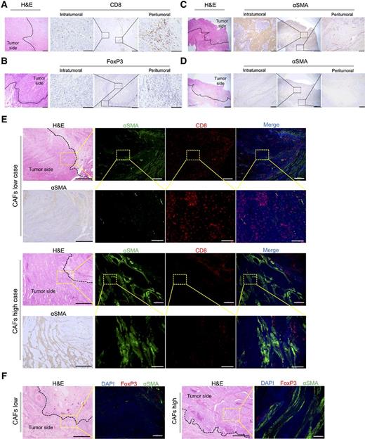 Figure 1. Relative distribution of TILs and CAFs in surgically resected human esophageal cancer samples. A, IHC for CD8-expressing T cells is shown at low and high magnification (40× and 400×). The distribution of CD8+ TILs is different between intratumoral and peritumoral tissue. B, IHC for FoxP3 expression is shown. A and B, Scale bars: 1 mm (HE, 40×), 100 μm (400×). C and D, IHC for αSMA+ CAFs shows a variable distribution in intratumoral tissue between different cases, but no differences for peritumoral tissues. Scale bars: 2 mm (HE, IHC: 20 ×), 200 μm (100 ×). C, Representative example of a high-αSMA case. D, Representative example of a low-αSMA case. E and F, Double staining immunofluorescence (IF) images of CD8- or FoxP3-expressing lymphocytes and αSMA at middle and high magnification (100× and 400×). Scale bars: 1 mm (HE, IHC: 40×), 200 μm (100×), 50 μm (400×). E, CD8+ TILs in intratumoral tissues are present at high numbers in a low-CAF case and at low numbers in a high-CAF case. F, In contrast, FoxP3+ TIL numbers in intratumoral tissues are high in a high-CAF case and low in a low-CAF case.