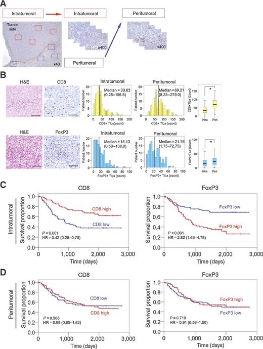 Figure 2. Correlation between CD8+ and FoxP3+ TIL distribution and clinical outcome in 140 cases of esophageal cancer. A, Protocol for area selection. The intra-/peritumoral border was first defined at low magnification (40×). Four areas with the most abundant lymphocytes under high magnification (400×) were then selected for both intra- and peritumoral sites in each specimen. B, The average number of CD8+ or FoxP3+ TILs was recorded using ImageJ (n = 140 per group; black bar indicates median). CD8+ and FoxP3+ TILs in peritumoral tissues were more numerous than in intratumoral sites (CD8+, P < 0.001; FoxP3+, P = 0.034; Student t test). Scale bars: 50 μm. C, OS curves according to CD8+ and FoxP3+ TIL number (high or low groups) in intratumoral tissues. The CD8+ high group showed significantly better prognosis, whereas the FoxP3+ high group showed significantly worse prognosis (Cox regression hazard model, 95% confidence intervals, and log-rank test). D, Survival curves for TIL distribution in peritumoral tissues. No significant difference in outcome was detected for the high/low groups of CD8+ and FoxP3+.