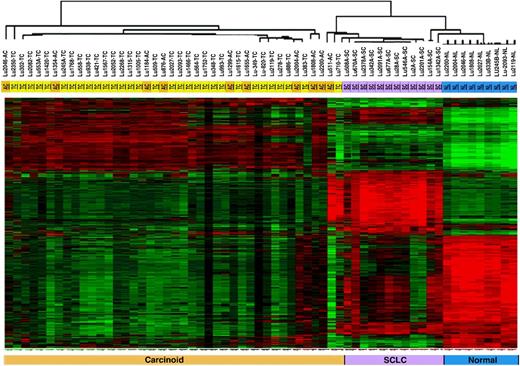 Figure 1. Clustering of gene expression segregates carcinoids from SCLC but does not distinguish between TC and AC. A total of 1,181 genes were filtered by P < 0.001 and |fold change| > 3 were clustered for 64 human lung samples, including 31 TC, 11 AC, 12 SCLC, and 10 corresponding normal lung tissue (NL).