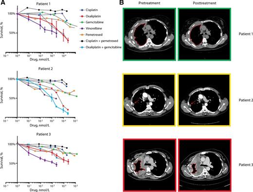 Figure 4. Dose–response curves and clinical responses of 3 patients. A, Dose–response curves of primary mesothelioma cells isolated from patients 1 to 3 and treated with several single agents and combinations of cytotoxic drugs, as indicated. Cell viability measured after 72 hours of drug exposure as a function of increasing concentrations of several drugs and combinations is depicted. B, CT scans of patients 1 to 3 before and after treatment with the drugs selected based on the in vitro drug screens. Response evaluation was done using modified RECIST for mesothelioma. Colored boxes around CT scans indicate in vitro response prediction before treatment and the actual response after treatment. Green: partial response, yellow: stable disease, red: progressive disease. Patient 1 was treated with a combination of oxaliplatin and vinorelbine. The tumor rind indicated by the red line is irregular on her pretreatment scan and is smaller and smoother on her scan following treatment, indicating a partial response. Patient 2 received a combination of oxaliplatin and gemcitabine. The tumor nodule indicated by the red arrow remains similar between the scans, indicating stable disease. Patient 3 received successively carboplatin/gemcitabine and oxaliplatin/vinorelbine. The gray tumor rind on the pretreatment scan—encircled by the red line—is larger on the posttreatment scan, which illustrates progressive disease.
