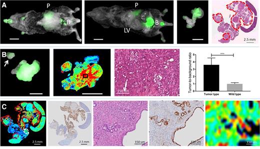 Figure 5. Fluorescent imaging and validation of R01-MG-IRDye800 in transgenic mice model at 800 nm with fluorescence shown in overlay mode. A, In vivo fluorescent imaging of mouse with pancreatic cancer, showing agent excretion via the kidneys in mouse with skin and without skin. In addition, ex vivo fluorescent imaging of resected pancreas with localized fluorescence and corresponding H&E section of entire pancreas with tumor localizations (outlined in red). B,Ex vivo fluorescent imaging of primary tumor with subcentimeter metastasis on the bowel (white arrow), and corresponding fluorescence intensity scan with Odyssey Imaging System (LI-COR) showing high fluorescence in tumor areas, with corresponding H&E section of PDAC (black box). In addition, a graphic representation of mean TBR in transgenic mice of tumor versus normal pancreas (P < 0.001). C, IHC correlation between fluorescent signal, tumor status, and αvβ6 expression. Scale bar, 1 cm, unless indicated differently. P, pancreas; B, bladder; LV, liver. Graphs are mean ± SD.