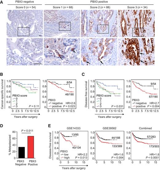 Figure 6. PBX3 expression in colorectal cancer indicates poor prognosis. A, Assessment of PBX3 immunostaining in primary human colorectal cancers. Tumors were assigned semiquantitative expression scores from 0 (no staining) to 3 (strong staining) and accordingly categorized as PBX3 negative (score 0) and positive (scores 1–3). Arrows indicate stained tumor cells. Case numbers per score are indicated; scale bars, 100 μm. B and C, Kaplan–Meier plots for different PBX3 expression scores and categories in a collection of n = 244 stage II colorectal cancers for (B) cancer-specific survival and (C) disease-free survival. HR, hazard ratio for PBX3-positive cases. P values are log-rank test results. Ratios on curves indicate the number of events over the number of patients per group. D, Association of PBX3 expression and liver metastasis in a matched case control collection of colon cancers. The P value is χ2 test result. E, PBX3 mRNA expression and survival association in two individual and combined datasets of a total of n = 786 colon cancers. GEO accession numbers of individual datasets are indicated. Kaplan–Meier plots for cases with low and high PBX3 expression. HR for PBX3 high cases. P values are log-rank test results. Ratios on curves indicate the number of events over the number of patients per group.