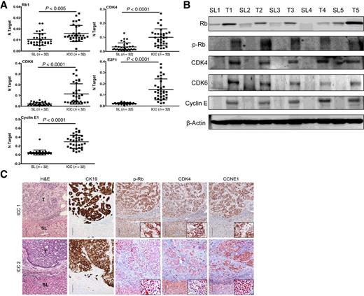 Figure 1. Activation of the CDK4/6 axis in human ICC specimens. A, qRT-PCR analysis of Rb1, CDK4, CDK6, E2F1, and Cyclin E1 mRNA levels in 32 paired human ICC and nontumorous surrounding liver tissues (SL). B, Representative Western blot analysis of Rb, phosphorylated/inactivated (p)-Rb, CDK4, CDK6, and Cyclin E in nontumorous livers (SL) and ICC samples (n = 32). β-Actin was used as loading control. C, Representative immunohistochemical patterns of phosphorylated/inactivated retinoblastoma protein (p-Rb), CDK4, and Cyclin E1 (CCNE1) in two human ICC1 and ICC2 specimens. Although normal surrounding nontumorous liver tissues (SL) exhibited faint or absent nuclear immunoreactivity for p-RB, CDK4, and CCNE1, the corresponding tumor part (T) showed strong nuclear immunolabeling for the same proteins. Nuclear immunoreactivity for the investigated proteins can be better appreciated at higher magnification (insets). CK19 staining indicates the biliary nature of ICC cells. In ICC2 immunohistochemistry (bottom), the Vector NovaRED Peroxidase Substrate was applied to intensify the signal. Magnification, ×100 in whole pictures, ×400 in insets; scale bar, 100 μm.