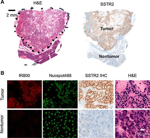 Figure 6. Ga-MMC(IR800)-TOC binding in human NET biospecimens. A, H&E and SSTR2 IHC staining of frozen sections prepared from a surgically resected human pancreatic NET. B, Ex vivo staining of an unfixed frozen section from the same tumor with Ga-MMC(IR800)-TOC. Nuclei were counterstained with Nucspot488. H&E staining was conducted for morphologic reference.