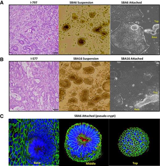 Figure 3. Morphologic similarities of tumors in situ and in tumor-derived cell lines in vitro. A, Representative images of sample I-797, showing in situ tumor staining with H&E (left), tumor-derived cells cultured in low-attachment culture dishes (suspension; middle), and tumor-derived cells cultured in extracellular matrix (ECM)–coated tissue culture dishes (attached; right). B, Representative images of sample I-577 under the same conditions as in A. Note the pseudocrypt formation by both cell lines. C, A 3D-reconstructed pseudocrypt derived from SBA-6 shown from base to top and stained with anti–EGFR-Y1068 (red), anti–E-cadherin (green), and nuclear stain (blue). Note distribution of active EGFR within the pseudocrypt structure.