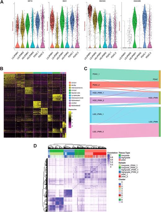 Figure 2. A, Violin plots of gene expression across lesion types confirm expression of characteristic PDAC and cystic preneoplasia-related markers. B, Heat map of the top 20 differentially expressed genes used to identify cell phenotypes across each of the 10 discrete clusters indicated by the header. C, Sankey diagram demonstrating epithelial cells profiled from LGD-IPMNs, HGD-IPMNS, and PDAC tissue and where they reside within annotated tSNE clusters. D, Correlation heat map of Pearson correlation coefficients of hierarchically clustered individual cells across all lesions, identified by originating lesion type and tSNE cluster.