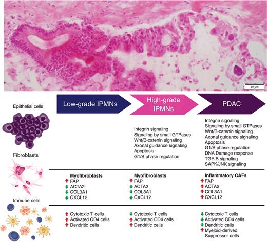 Figure 4. Schematic representation of evolving molecular and phenotypic signatures during preneoplastic progression of pancreatic cancer.
