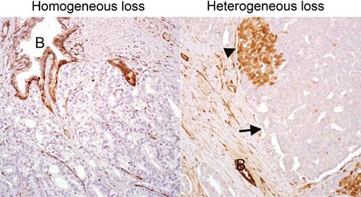 Figure 2. p27 immunostaining in African-American prostate tumors with CDKN1B deep deletions. Both cases showed deep deletions of CDKN1B by sequencing, however the tumor on the left demonstrates homogeneous loss of p27 protein, suggestive of a clonal alteration, whereas the tumor on the right shows heterogeneous loss of p27 in some (arrow) but not all (arrowhead) tumor cells, suggestive of a subclonal alteration in CDKN1B. In both cases, benign glands (B) provide an internal positive control for p27 staining. All images reduced from 200× magnification.