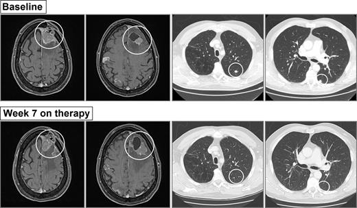 Figure 3. This patient with melanoma had significantly larger volume of disease in the brain than extracranially (SCC11-0270). Patient received single-agent nivolumab, and the restaging scan after 7 weeks confirmed disease progression in the brain and CR in the lung (only site of extracranial disease). Metastases on CT and magnetic resonance images are circled in white.