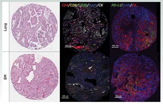 Figure 1. Detection of TILs and PD-L1 expression in a primary lung tumor (Lung, top) and corresponding brain metastasis (BM, bottom). Representative microphotographs from tissue microarrays showing the histology features of hematoxylin & eosin–stained preparations (left) and levels/distribution of major B- and T-cell populations and PD-L1 protein using multiplexed immunofluorescence (center and right). The color code for each target in the fluorescence analysis is indicated within the panels. The histology aspect reveal reduced tumor differentiation of the brain lesion characterized by increased nuclear pleomorphism, reduction of acinar/glandular structures and a more solid architectural pattern. The stromal compartment shows marked reduction of immune cells and enhanced vascular structures. The immunofluorescence analysis shows prominent reduction of both CD4+ helper and CD8+ cytotoxic T cells in the metastatic lesion; and virtual absence of B cells. PD-L1 immunoreactivity was also lower in the secondary lesion and was localized predominantly in cytokeratin (CK)-positive tumor cells with membranous/cytoplasmic staining pattern. Left, H-E; middle, representative fluorescence pictures showing DAPI (blue), cytokeratin (CK, white), CD4 (red), CD8 (yellow), and CD20 (green) staining. Right, representative fluorescence pictures showing DAPI (blue), cytokeratin (CK, red), PD-L1 (green). Scale bar = 100 μm.