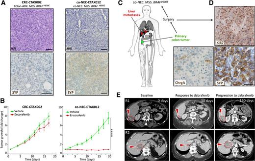Figure 2. co-NETs respond to BRAFTV600E blockade. A, Representative images showing the histology of a CRC (CTAX002) and a co-NEC (CTAX012) PDX model and their expression of synaptophysin (SYP). Scale bars, 100 μm. B, Both PDX models were treated with the BRAFV600E inhibitor encorafenib and tumor growth is shown. Ten animals were evaluated per each treatment. ****, P < 0.0001 of an unpaired t test with Welch correction comparing the tumor volume at endpoint measurements. C, Diagram showing the lesions and histology of a patient presenting an advanced co-NEC with live metastases. D, Expression of proliferation (Ki67) and neuroendocrine carcinoma differentiation markers (Chromogranin A: ChrgA and SYP) are shown. Scale bar, 100 μm. E, CT images showing the response and progression of this same patient to BRAFV600E inhibition with dabrafenib. Arrows point to major liver lesions that are also delineated. ADK, adenocarcinoma; H/E, hematoxylin and eosin; MSS, microsatellite stable.