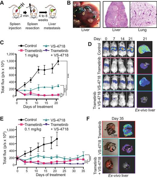 Figure 5. MEKi/FAKi combination reduces uveal melanoma cells growth in an in vivo liver metastasis model. A, Schematic of the hematogenous dissemination model for uveal melanoma liver metastasis using 92.1 GFP-Luc cells. B, Left, macroscopic view of liver metastasis 8 weeks after splenic injection. Right, H&E staining of liver and lung. C, Hepatic tumor burden tracked by IVIS imaging after injection of 92.1 uveal melanoma cells in SCID/NOD mice treated with vehicle (control), trametinib 1 mg/kg, VS-4718 50 mg/kg, or both. Data, mean ± SEM (6 mice/group). ***, P < 0.001; n.s., not significant. D, Representative mice treated with vehicle (control), trametinib 1 mg/kg, VS-4718 50 mg/kg, or both, at the indicated days of treatment, and representative ex vivo imaging of the liver obtained at day 21. E, Hepatic tumor burden tracked by IVIS imaging after injection of 92.1 uveal melanoma cells in SCID/NOD mice treated with vehicle (control), trametinib 0.1 mg/kg, VS-4718 50 mg/kg, or both. Data, mean ± SEM (5 mice/group). ***, P < 0.001; **, P < 0.01. F, Representative ex vivo imaging of the liver from mice treated for 35 days with trametinib 0.1 mg/kg, VS-4718 50 mg/kg, or both.