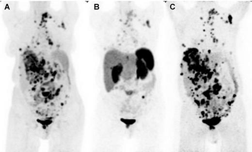 Figure 1. Selection of HSA-131I-MIBG over PRRT for metastatic paraganglioma based on superior norepinephrine transporter expression imaged by 124I-MIBG PET/CT and compared with 18F-FDG PET/CT. The anterior maximum intensity projection images of 18F-FDG PET-CT(A), SSTRI by 68Ga-DOTATATE PET/CT (B), and norepinephrine transporter imaging by 124I-MIBG PET/CT (C) in a case of widely metastatic paraganglioma. 124I-MIBG demonstrates more disease sites than 18F-FDG, as well as has significantly more intense and numerous lesion uptake than 68Ga-DOTATATE, making MIBG therapy the preferred option for treatment in this case. Advantages of comparing PET (68Ga-DOTATATE) with PET (124I-MIBG) and ability to do prospective dosimetry are potential advantages of 124I-MIBG over 123I-MIBG, although this technique is not widely available.