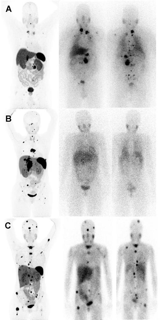 Figure 2. Selection of HSA-131I-MIBG versus PRRT for metastatic pheochromocytoma/paraganglioma based on expression of somatostatin receptor and norepinephrine transporter. A, Superior detection of tumors by norepinephrine transporter imaging by 123I-MIBG (anterior and posterior planar images on the right) <a href=