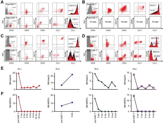 Figure 2. Immunotypic features of enrolled AML cases before and after anti-CLL1 CAR T-cell treatment. The BM immunophenotypic feature of enrolled patients before and 2 weeks after anti-CLL1 CAR T-cell therapy patient 1 (A), patient 2 (B), patient 3 (C), and patient 4 (D). The BM morphologic blast percentage (E), and MRD response (F) during anti-CLL1 CAR T-cell treatment for R/R-AML (red line with solid circle, patient 1; blue line with solid square, patient 2; dark green with solid circle, patient 3; purple line with empty square, patient 4).