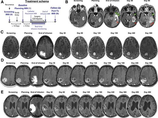 Modified RANO, Immunotherapy RANO, and Standard RANO Response to ...