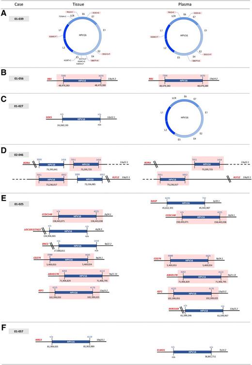 Figure 1. Examples of the respective HPV status found in tumor and plasma DNA samples from the same patient, using the CaptHPV technique. A, Only episomal form of the viral genome with 50% common SNPs found in both tumor and plasma; B, Identical hybrid viral-genome sequences corresponding to a single HPV integration site found in the two specimens; C, Hybrid viral-genome detected in tumor DNA corresponding to a unique integration site, whereas only viral episomes found in plasma; D, Multiple viral-cell junctions clustered at the same chromosomal locus in tumor and plasma; E, Multiple hybrids corresponding to HPV integration loci scattered at different chromosome sites in tumor and plasma; F, Different hybrids corresponding to distinct viral integration sites detected in tumor and plasma. Names of target genes are in red. A double bar indicates that the HPV insertion is not within the gene locus and the closest gene is indicated in red. Hg38 reference genome has been used for the genomic coordinates indicated below the HPV box and the chromosomal loci. HPV breakpoints are reported above the HPV box. Hybrids or SNPs shared in common in tumor and plasma samples are indicated by a pink-colored box.