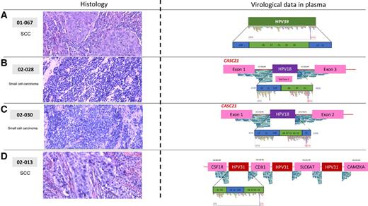Figure 2. Virologic data from plasma analyses (right) in comparison with tumor histology (left) in patients with cervical carcinoma. SCC (A) with circulating HPV39 DNA sequences covering the whole viral genome (episomal form). Two cases of small-cell carcinoma with circulating HPV18 DNA sequences showing viral DNA inserted within the CASC21 gene, between exon 1 and exon 3 in B with gene disruption and loss of the exon 2, and between exon 1 and exon 2 in C. D, SCC with circulating HPV31 DNA sequences showing viral DNA inserted at the 5q32 chromosomal band with a complex pattern involving the CAM2KA, SLC6A7, CSF1R, and CDX1 genes located at this locus.