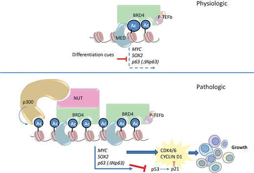 Figure 1. Mechanistic model of how BRD4-NUT drives growth and blocks differentiation in NUT carcinoma. Top, the normal function of BRD4 is to facilitate transcriptional elongation in a manner that can be regulated by changes in cell state, such as prodifferentiative signaling (i.e., TGFβ signaling). Bottom, in the pathologic state, when BRD4 is fused to NUT, the recruitment of p300 leads to the formation of hyperacetylated megadomains whose transcriptional activation of oncogenic target genes are resistant to negative regulatory signals due to their large size. Ac, acetyl-lysine; MED, mediator complex. Material from ref. 8.