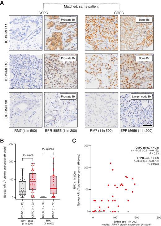 Figure 3. AR-V7 protein quantification by two IHC assays in matched, same patient, castration-sensitive and castration-resistant prostate cancer tissue biopsies. A, Representative micrographs of AR-V7 protein detection by IHC using EPR15656 (Abcam, 1 in 200) and RM7 (RevMAb, 1 in 500) antibodies in three patients with matched CSPC and CRPC tissue biopsies from the Institute of Cancer Research/Royal Marsden Hospital (ICR/RMH) matched CSPC and CRPC cohort (scale bar: 50 μm). Prostate, lymph node, and bone biopsies (Bx) are shown. B, Nuclear AR-V7 staining (H-score) using EPR15656 (23 CSPC and 32 CRPC) and RM7 (26 CSPC and 32 CRPC) antibodies was determined. Box shows median and interquartile range; bars show minimum and maximum values. Statistical significance between differences was measured by Mann–Whitney tests. C, Nuclear AR-V7 staining (H-score) for EPR15656 and RM7 in the same 23 CSPC (gray) and 32 CRPC (red) biopsies is shown. Statistical significance between correlations was determined by Spearman rank.