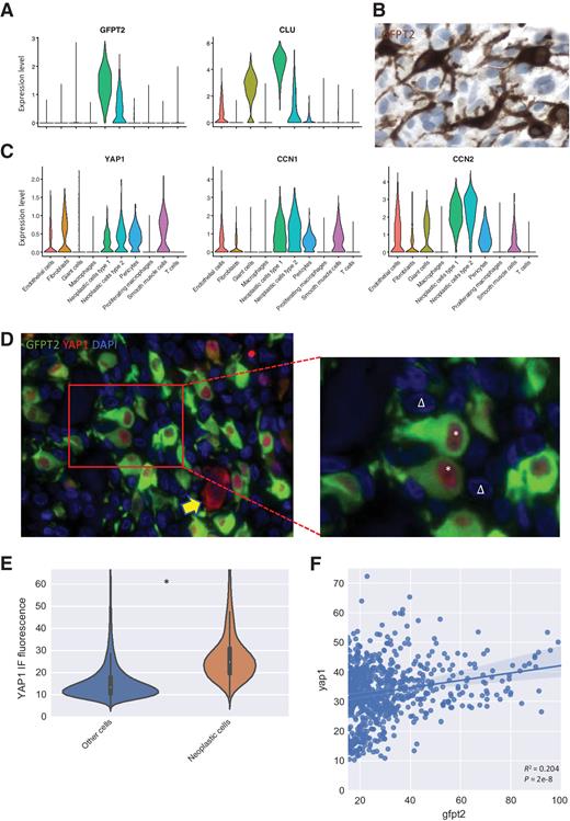 Figure 3. GFPT2 is a specific marker for neoplastic cells in TGCT. GFPT2 highlights the dendritic nature of the neoplastic cells and its high expression is associated with activation of the HIPPO signaling pathway. A, scRNA-seq gene expression levels for GFPT2 and CLU in all cell types found in TGCT. GFPT2 is specific to the two neoplastic cell clusters with higher expression in neoplastic cell cluster 1. CLU is highly expressed in the neoplastic cells as well but is also present in giant cells and endothelial cells. B, IHC highlights the dendritic appearance of the GFPT2 positive cells. The GFPT2+ cells are surrounded by GFPT2- cells with smaller nuclei. C, scRNA-seq gene expression levels for YAP1, CCN1, and CCN2 showing expression in both neoplastic cells clusters. D, IF stain for GFPT2 and YAP1 shows nuclear localization of YAP1 in the neoplastic GFPT2+ cells (*) in an area chosen to contain a dense concentration of neoplastic cells. The surrounding GFPT2- cells do not show nuclear expression of YAP1 (∆). Some GFPT2 negative cells show YAP1 in the cytoplasm but not in the nucleus (yellow arrow). E, YAP1 IF signal quantification in GFPT2- and GFPT2+ cells. GFPT2+ cells show a significantly higher (* = P < 0.05) expression of nuclear YAP1. F, Quantification of the IF signal intensity for cytoplasmic GFPT2 and nuclear YAP1 within the group of GFPT2+ cells. A significant (P = 2e-8) Pearson correlation was found between the signal intensities (R2 = 0.204).