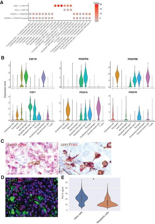 Figure 4. Ligand–receptor interactions for the neoplastic cells in TGCT show absence of an autocrine loop involving CSF1 signaling. A, CellphoneDB identified interactions involving CSF1, IL34, and PDGFA and -B between the neoplastic cell clusters and other cell subtypes. B, scRNA-seq expression of the receptors (CSF1R, PDGFRA, and PDGFRB) and ligands (CSF1, PDGFA, and PDGFB). C, Combined GFPT2 (IHC) and CSF1R or CSF1 (RNA-ISH). GFPT2 and CSF1 co-localize while the GFPT2+ cells are negative for CSF1R mRNA. D, IF for GFPT2 and PU.1. GFPT2+ cells are negative for PU.1. E, Nuclear PU.1 signal intensity was quantified for the GFPT2+ and GFPT2- cells, showing a significantly higher (* = P < 0.05) nuclear signal in the GFPT- cells.