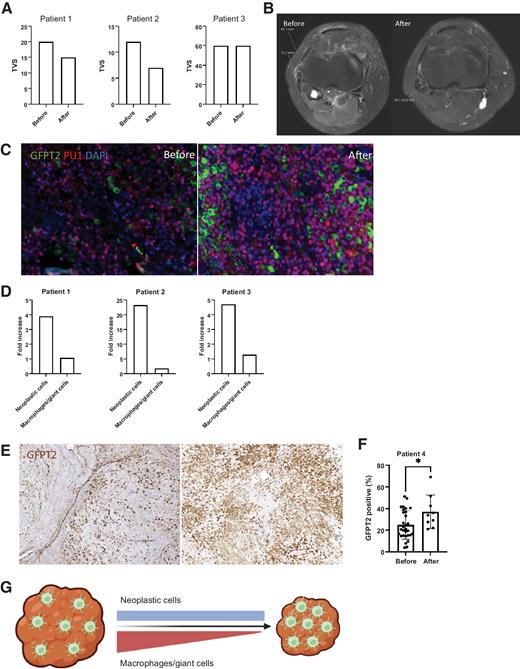 Figure 5. Small molecule and antibody treatments targeting the CSF1R pathway led to a radiologic decrease in tumor volume. This treatment however does not target the neoplastic cells. In 4 patients with TGCT treated with three different CSF1R inhibitors an increase in number of neoplastic cells per microscopic field is shown. A, Patients 1 and 2 were treated with pexidartinib and patient 3 was treated with nilotinib. TVS decreased in patients 1 and 2 and remained stable in patient 3 during the treatment. B, MRI image from patient 2 before (left) and after (right) systemic pexidartinib treatment. C, IF for GFPT2 and PU.1 was performed on patients 1–3. Left panel shows a representative image before pexidartinib treatment and right panel shows the same patient after pexidartinib treatment. D, The fraction of GFPT2-positive and PU.1-positive cells was determined before and after treatment in a total area of 2.94 mm2. The bar graph shows the fold increase in both the neoplastic cells (GFPT2-positive) and macrophages and giant cells (PU.1-positive) after treatment. The three patients all show a strong increase in neoplastic cells and the fraction of macrophages per field remains relatively stable. E, IHC for GFPT2, representative image from 5 patients that did not receive CSF1R inhibitor therapy (left) and from a patient that was treated with cabiralizumab (right) shows an increase in GFPT2-positive cells per microscopic field. F, The number of GFPT2-positive cells from 30 40x fields from 5 untreated patients with a total area of 2.94 mm2 was compared with 9 fields with a total area of 0.88 mm2 from a patient after cabiralizumab treatment. A significant (P < 0.05) increase in GFPT2-positive cells was found. G, Schematic overview showing the decrease in tumor volume due to CSF1R inhibitor treatment that affects macrophages and giant cells but leaves the neoplastic cells unaffected.