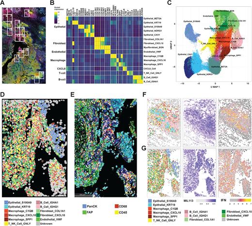 Figure 3. CosMx Spatial Imaging identifies subasumstat-responsive cells in CIVO microinjected tumors. A, Formalin-fixed, paraffin-embedded sections of tumor from patient 7 stained with DAPI, panCK, and MIL113 adjacent to the section used in the CosMx analysis. Boxes represent fields of view (FOV) collected. B, Differentially expressed genes used to identify cell types in UMAP clusters. Genes were identified for clusters from UMAP projection using the FindAllMarkers function in Seurat using parameters only.pos = TRUE, min.pct = 0.25, and logfc.threshold = 0.25. The top three genes for each cluster are shown (see Supplementary Fig. S8A for all genes and cells). Expression is the average for each cell type of the scaled gene level data across tumors 7 and 8. On the basis of the identity of the genes for each cluster a cell type was established by reference to established marker sets. C, UMAP projection of 16 cell types identified from clustering of data from patients 7 and 8. UMAP clustering was performed in Seurat using a standard workflow following data normalization and PCA. Cells (n = 93,491) are colored according to the cell identities from (B). D, Spatial reconstruction of patient 7: FOV 14. Cell identities are based on UMAP cluster (C). E, IHC staining of adjacent section to (D) showing distribution of immune cells (CD45), macrophages (CD68), epithelial cells (PanCK), and fibroblasts (FAP). F, Patient 7: FOV 2 representing adjacent normal tissue region containing salivary gland exposed to subasumstat showing reconstruction of cell types, MIL113 staining intensity, and IFN signature expression in respective panels. Note that the MIL113 staining data are from an adjacent section. G, Patient 7: FOV 14 representing a region of tumor cells exposed to subasumstat showing reconstruction of cell types, MIL113 staining intensity, and IFN signature expression in respective panels. Note that the MIL113 staining data are from an adjacent section.