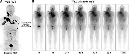Fibroblast Activation Protein-Targeted Radioligand Therapy with 177Lu ...