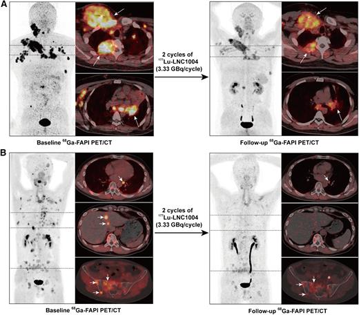 Fibroblast Activation Protein-Targeted Radioligand Therapy with 177Lu ...
