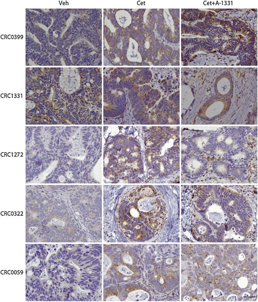 Figure 5. EGFR inhibition increases BIM protein levels in vivo, and high BIM abundance is maintained after concomitant inhibition of BCL-XL. Representative images of BIM immunoreactivity in PDXs after treatment for 5 weeks with cetuximab (20 mg/kg, intraperitoneal injection twice a week) or cetuximab plus A-1331852 (25 mg/kg, oral gavage 5 days a week). At the end of treatment, two to three tumors from 2 to 3 different mice were explanted and subjected to IHC analysis. Veh, vehicle; Cet, cetuximab; A-1331, A-133852. Scale bar, 50 μm.